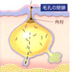 白色面皰